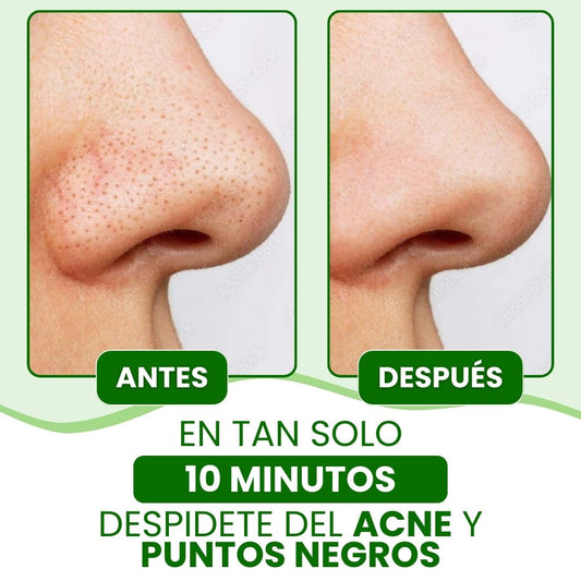 Lanbena®: Mascarilla avanzada para puntos negros