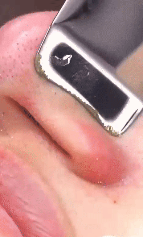 UltraScrub - Espátula Ultrasónica Facial